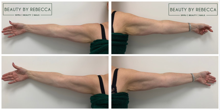 Body Sculpting Before and After